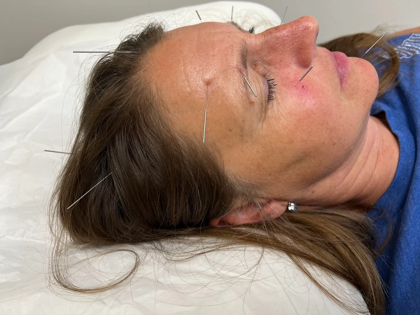Facial neuromuscular massage for Bell's Palsy recovery in Flushing Queens