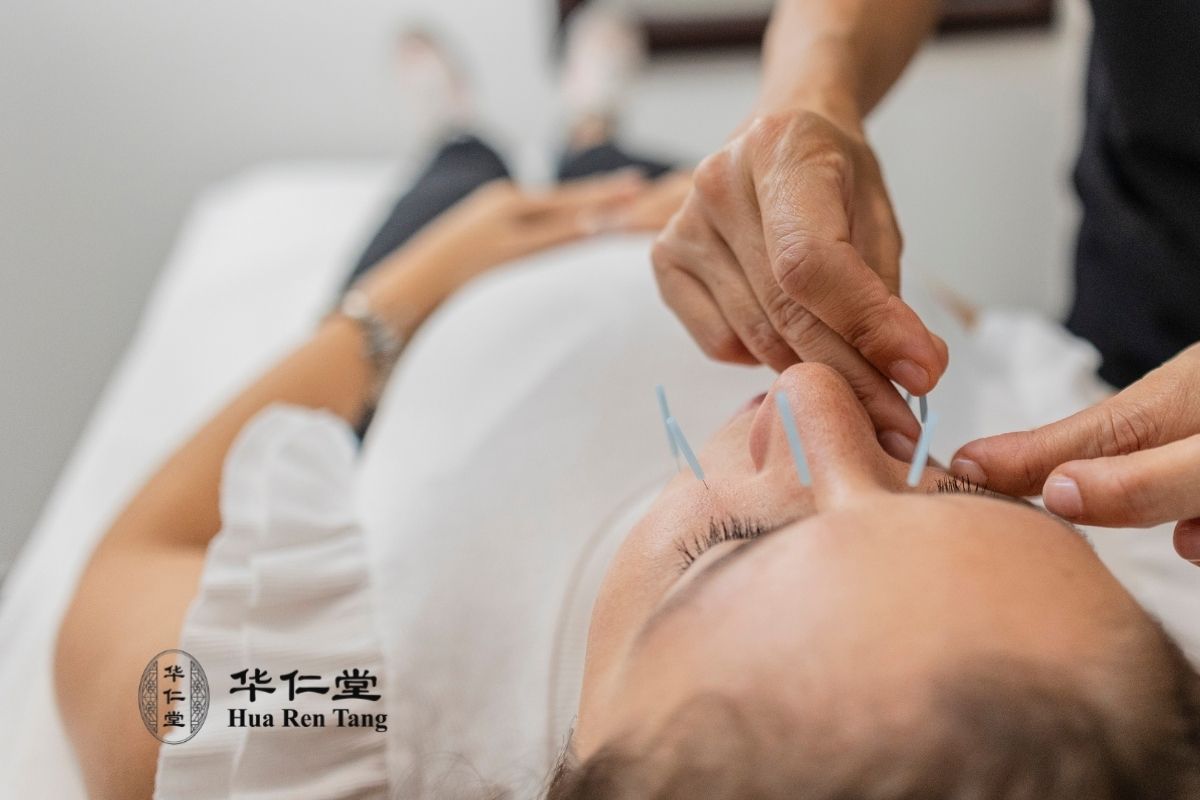 Bell's Palsy treatment diagram showing acupuncture points for facial nerve recovery